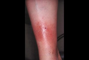 Redness (erythema) of the skin