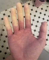 Pallor (blanching) of the hand