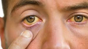 Jaundice (yellow cast) in the eyes