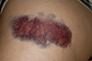 Bruising (hematoma) on the skin