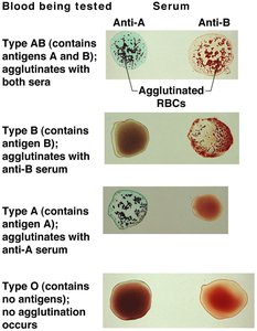Blood typing: agglutination reactions with anti-A and anti-B sera