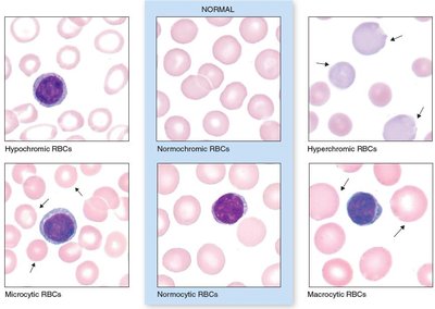 Blood smear showing RBC size and color abnormalities