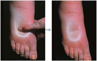 Pitting edema