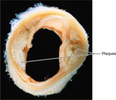 Cross-section of artery with atherosclerotic plaque