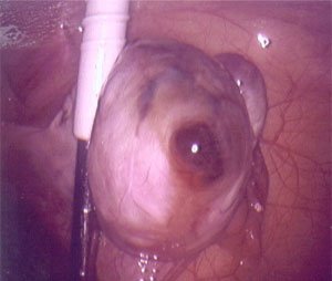 Gross image of corpus luteum in ovary