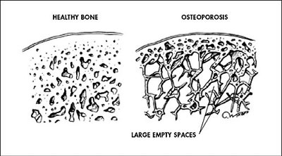Diagram comparing healthy bone and osteoporosis