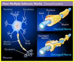 Multiple sclerosis demyelination