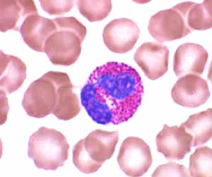 Eosinophil in blood smear