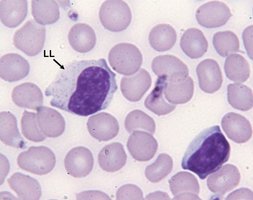 Small and large lymphocytes