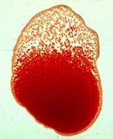 Agglutination reaction in blood typing