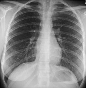 Chest X-ray showing thoracic cavity