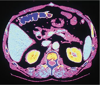 CT scan of abdominopelvic cavity