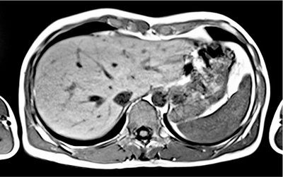 MRI scan of abdominopelvic cavity