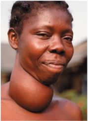 Goiter due to thyroid disorder