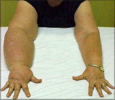 Lymphedema in the arm