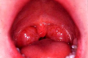 Severely inflamed tonsils