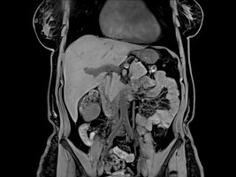 MRI image in frontal (coronal) plane