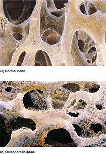 Comparison of normal bone and osteoporotic bone structure