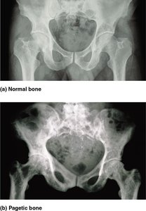 X-ray comparison of normal bone and pagetic bone
