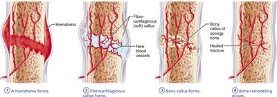 Stages of bone fracture healing