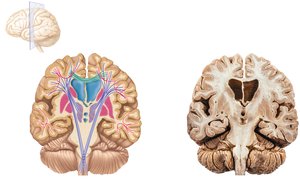 White fiber tracts of the cerebral hemispheres