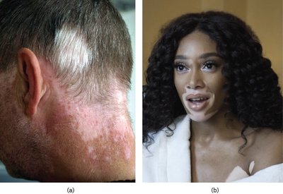 Vitiligo: depigmented patches on the skin