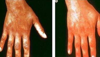 Vitiligo: patchy depigmentation of the hands
