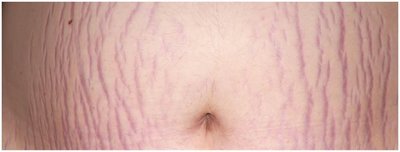 Stretch marks (striae)