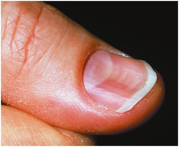 Koilonychia (spoon nail)