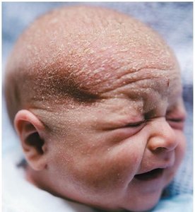 Cradle cap (seborrhea) in a newborn
