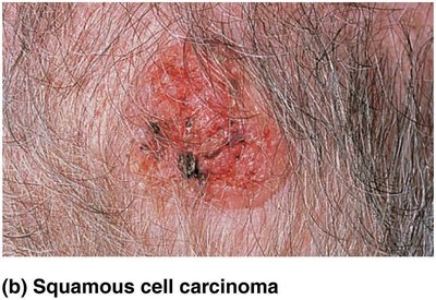 Squamous cell carcinoma