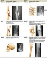 Examples of bone fracture types