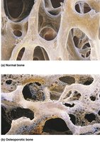 Normal vs osteoporotic bone
