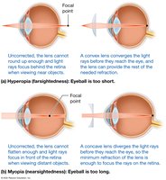 Myopia correction with concave lens