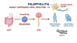 Diagram showing the pathogenesis of poliomyelitis from gut to CNS and its effects