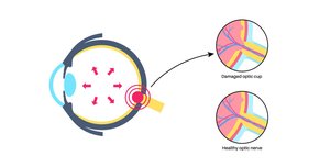Glaucoma and Optic Nerve Damage