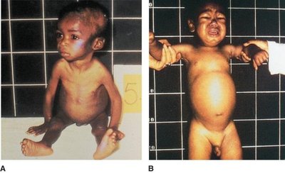 Images of marasmus and kwashiorkor