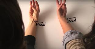 Presence and absence of palmaris longus tendon