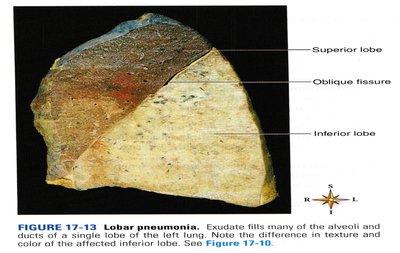 Lobar pneumonia in lung tissue