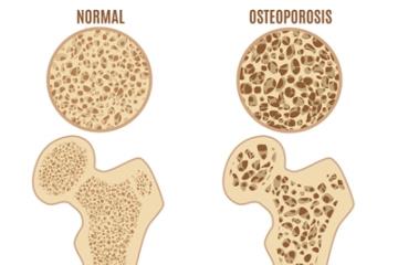 Comparison of normal bone and osteoporosis