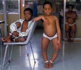 Children with rickets due to vitamin D deficiency