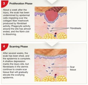 Proliferation and scarring phases of skin repair