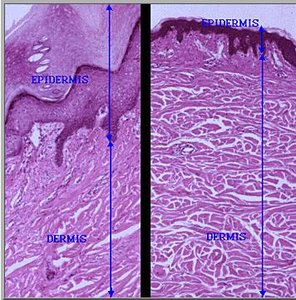 Comparison of thin and thick skin under microscope