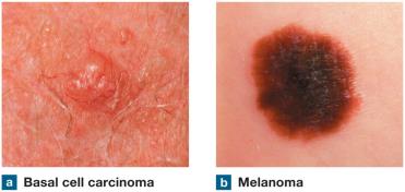 Basal cell carcinoma and melanoma comparison
