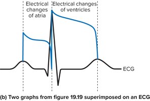 ECG with electrical changes of atria and ventricles
