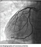 Angiography of coronary arteries