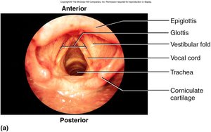 Endoscopic view of the larynx showing epiglottis, glottis, and vocal cords