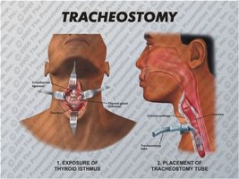 Diagram of tracheostomy procedure