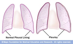 Normal pleural lining vs. pleurisy