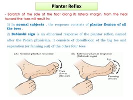 Diagram of the plantar reflex and Babinski sign
